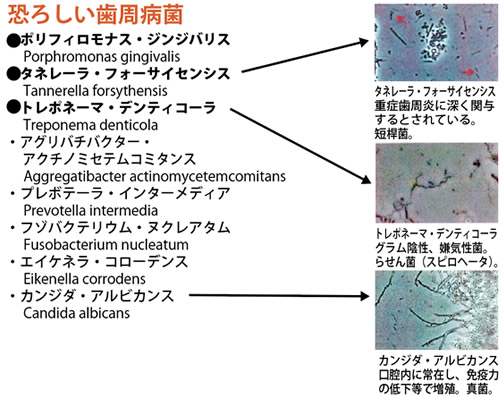 恐ろしい歯周病菌