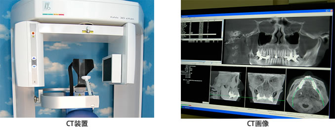 歯科用CT