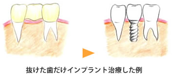 インプラント