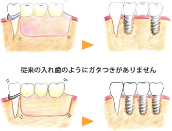 インプラント