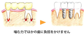 インプラント