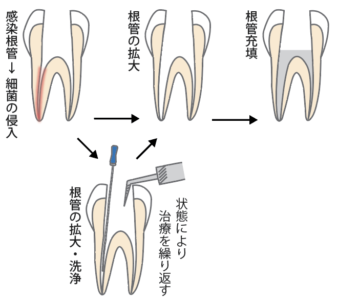 歯内療法