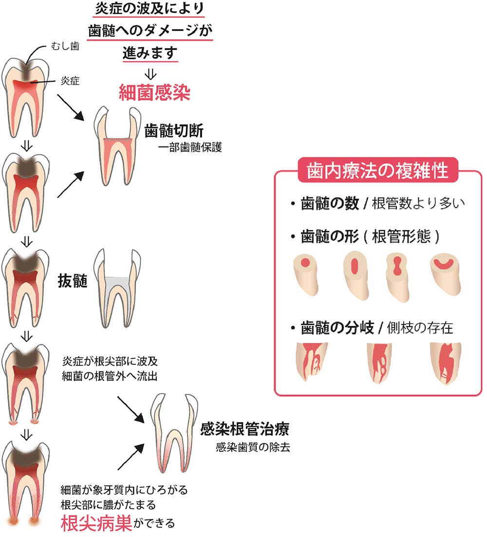 歯内療法