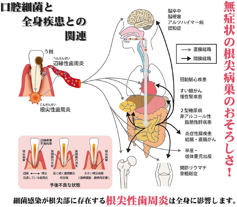 歯内療法