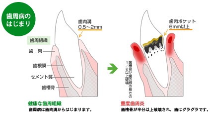 歯周病予防