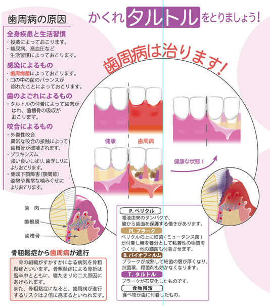 歯周病